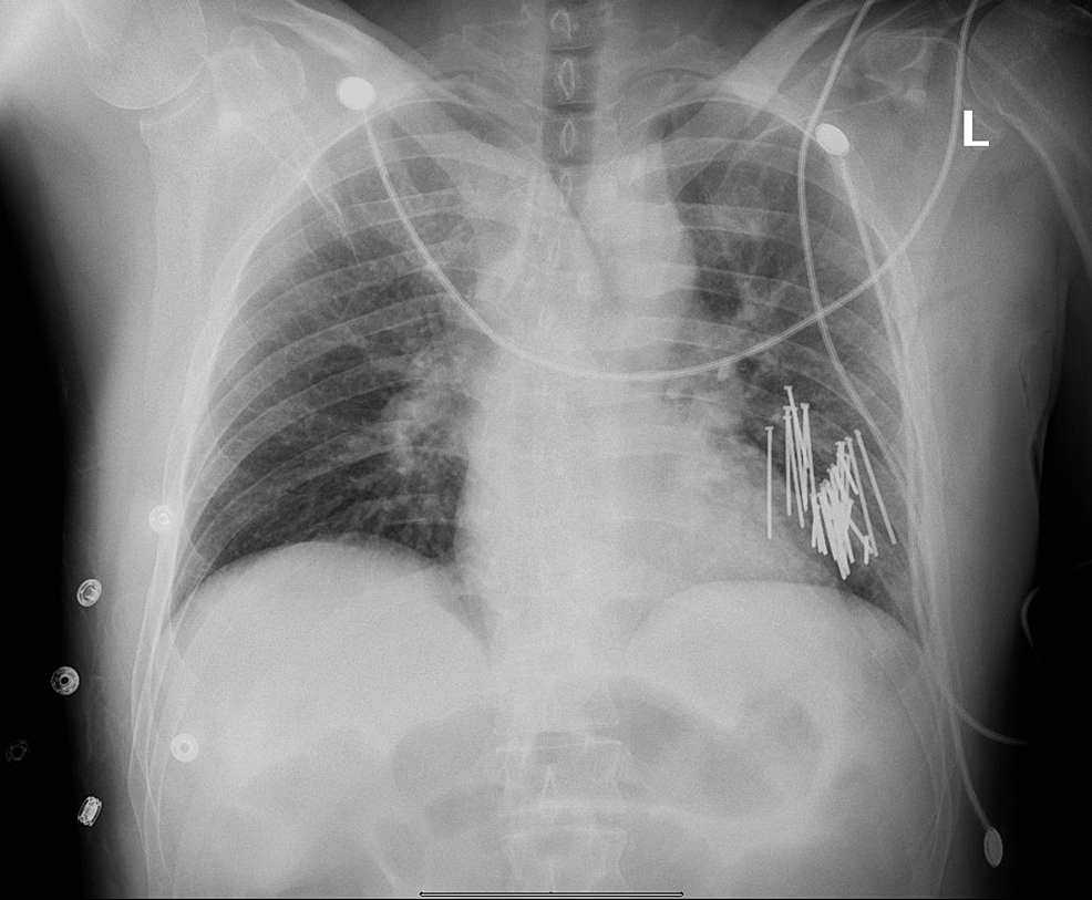 cureus-delayed-surgical-intervention-for-a-self-inflicted-left-chest