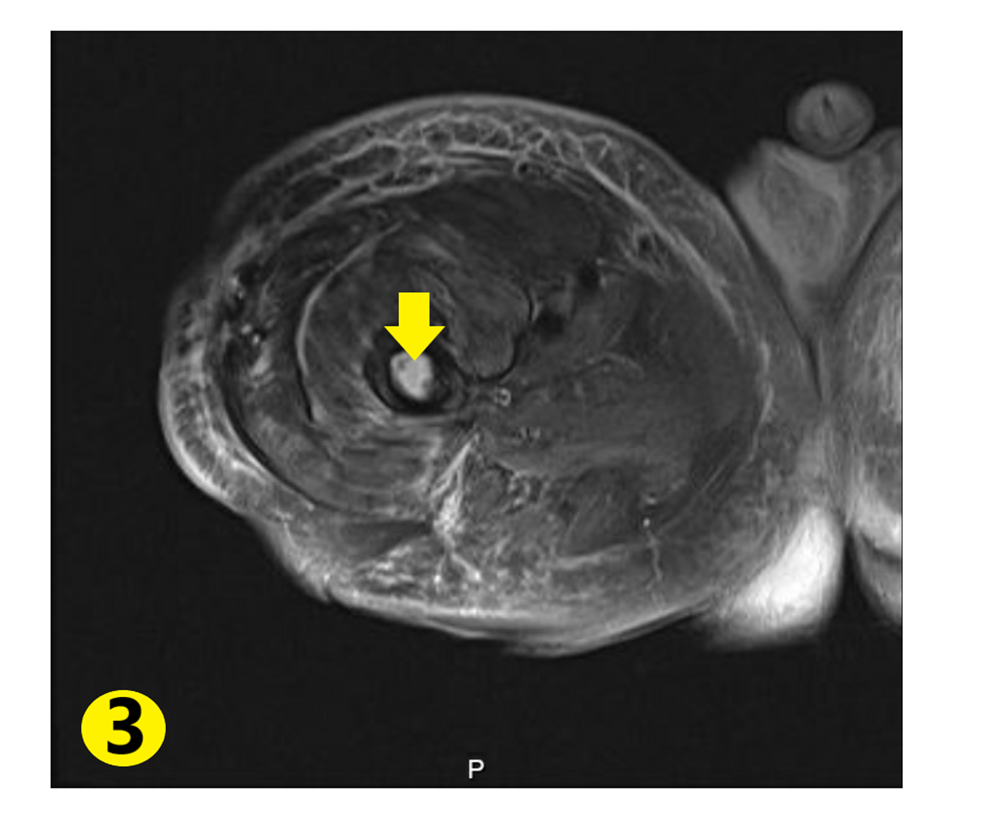 Cureus | Brodie's Abscess Masquerading as Vaso-occlusive ...