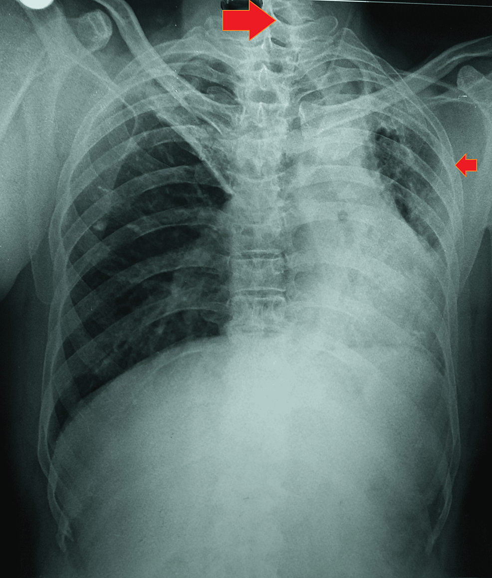 Post-tuberculosis Destroyed Lung Syndrome in an Indian Male: A Case ...