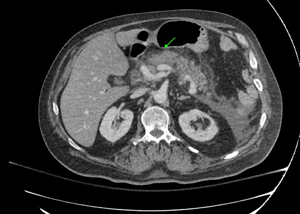 Computed-tomography-(CT)-finding-of-acute-pancreatitis-
