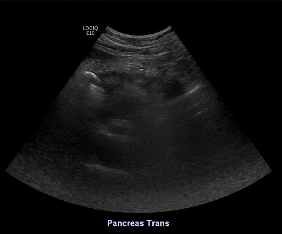Cureus | A Case Report of Mesenteric Panniculitis