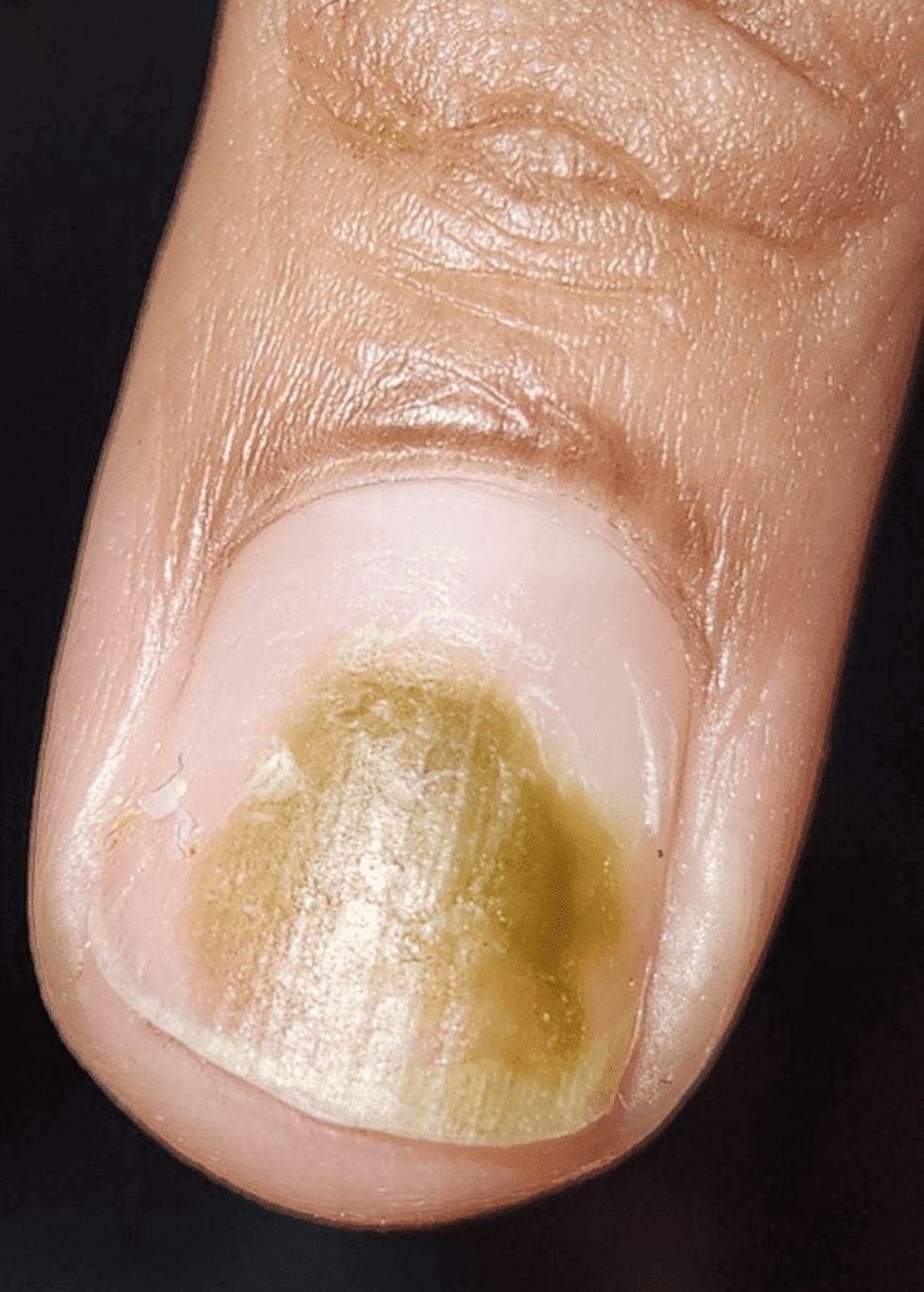 Inherited nail diseases - Dermatologie - Universimed - Medizin im Fokus