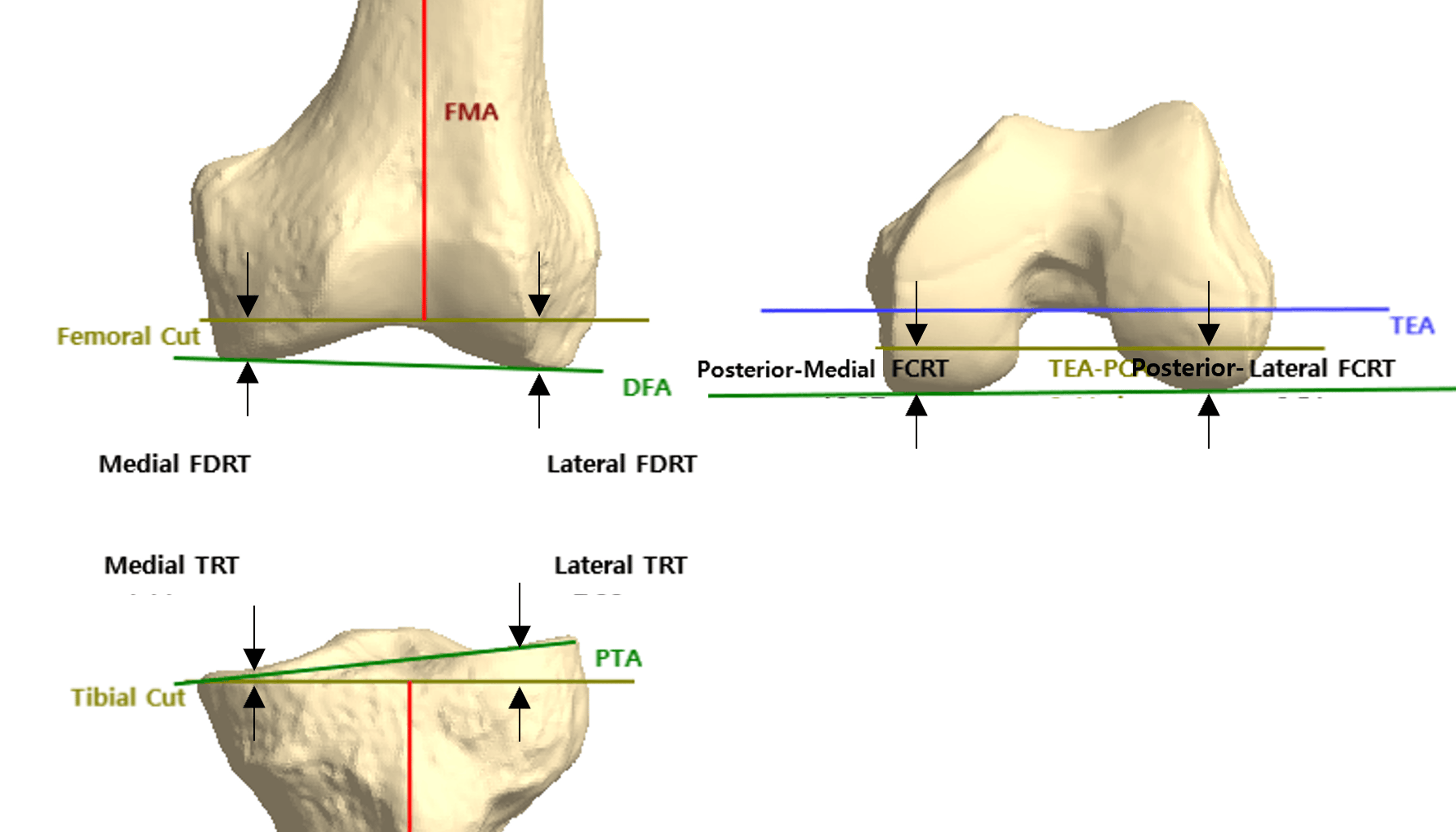 An Image Based Augmented Reality System For Achieving Accurate Bone Resection In Total Knee 9084