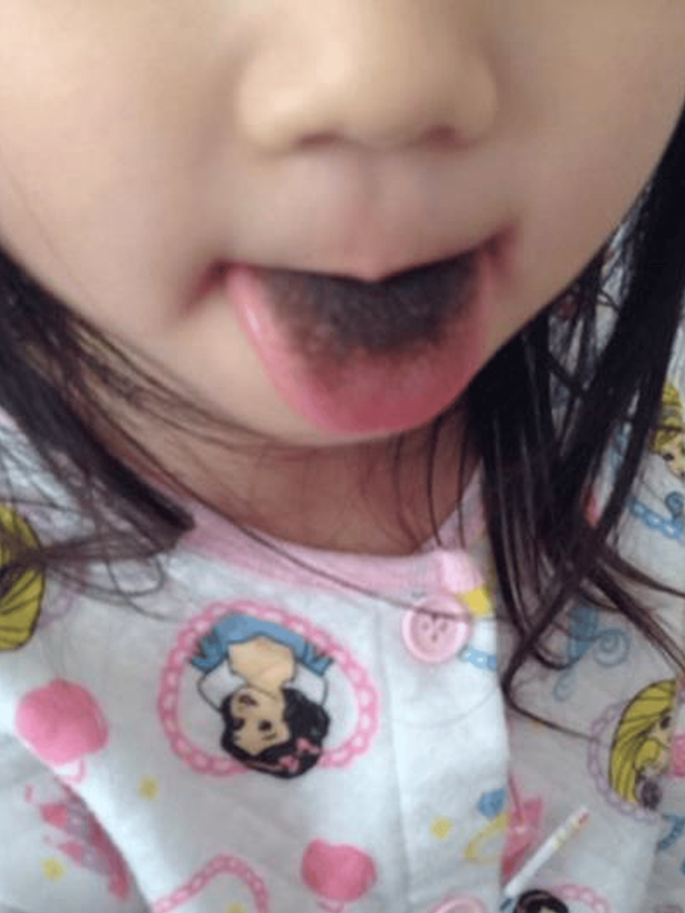 Black-hairy-tongue-during-linezolid-therapy-in-case-1.