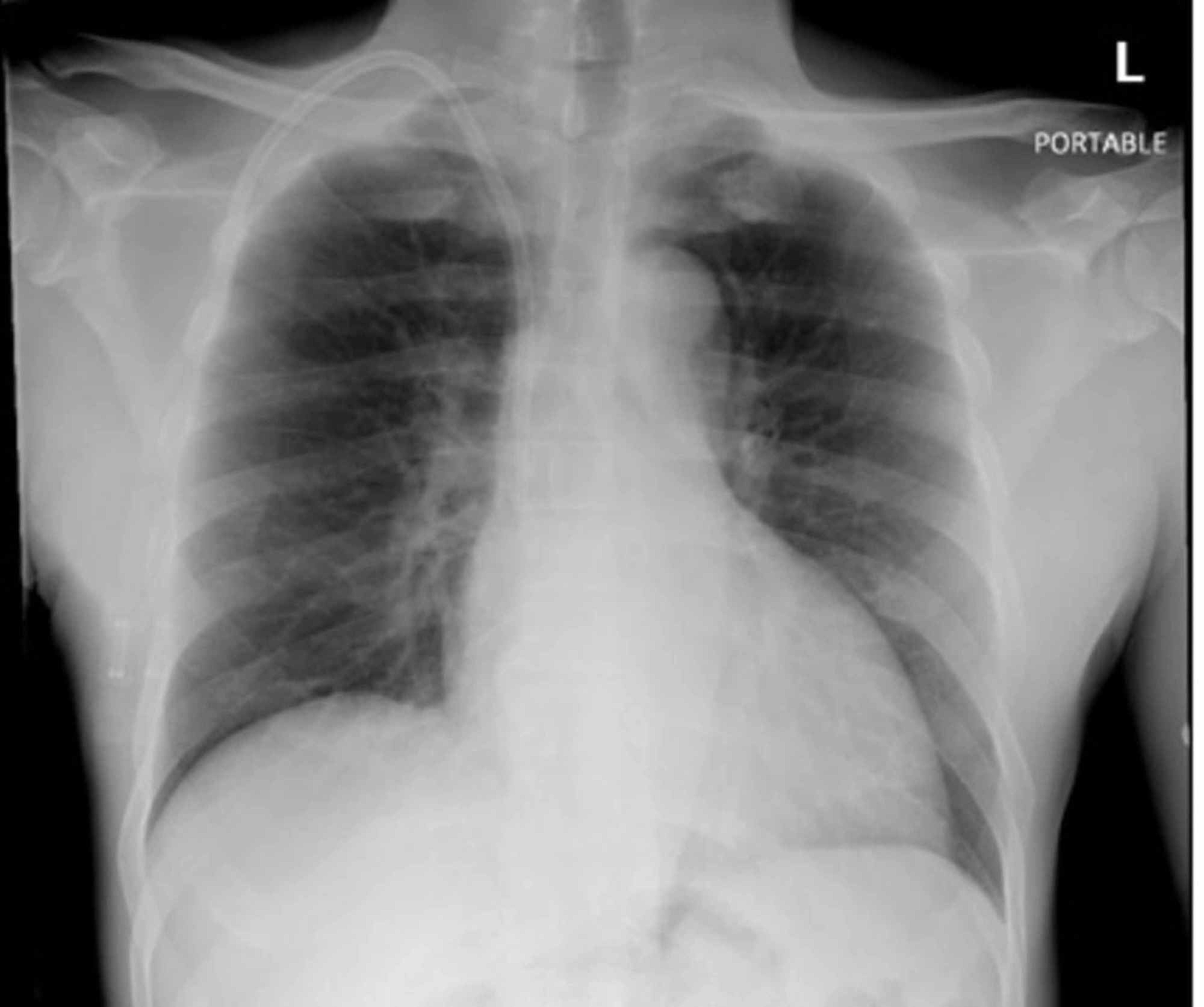 Cureus | Chryseobacterium indologenes, an Emerging Bacteria: A Case ...