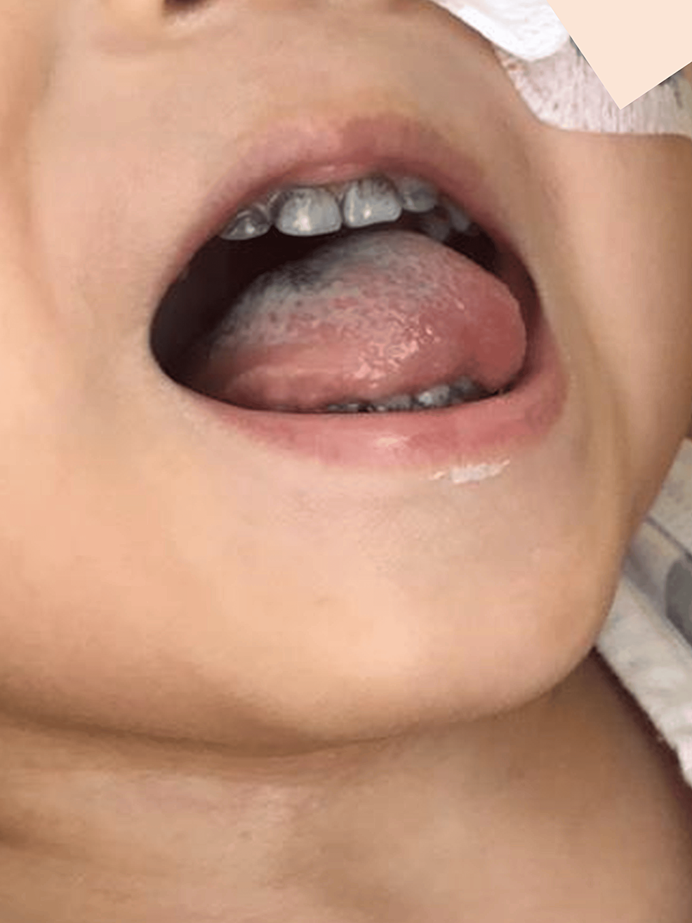 Tooth-discoloration-during-meropenem-and-vancomycin-therapy-in-case-2.