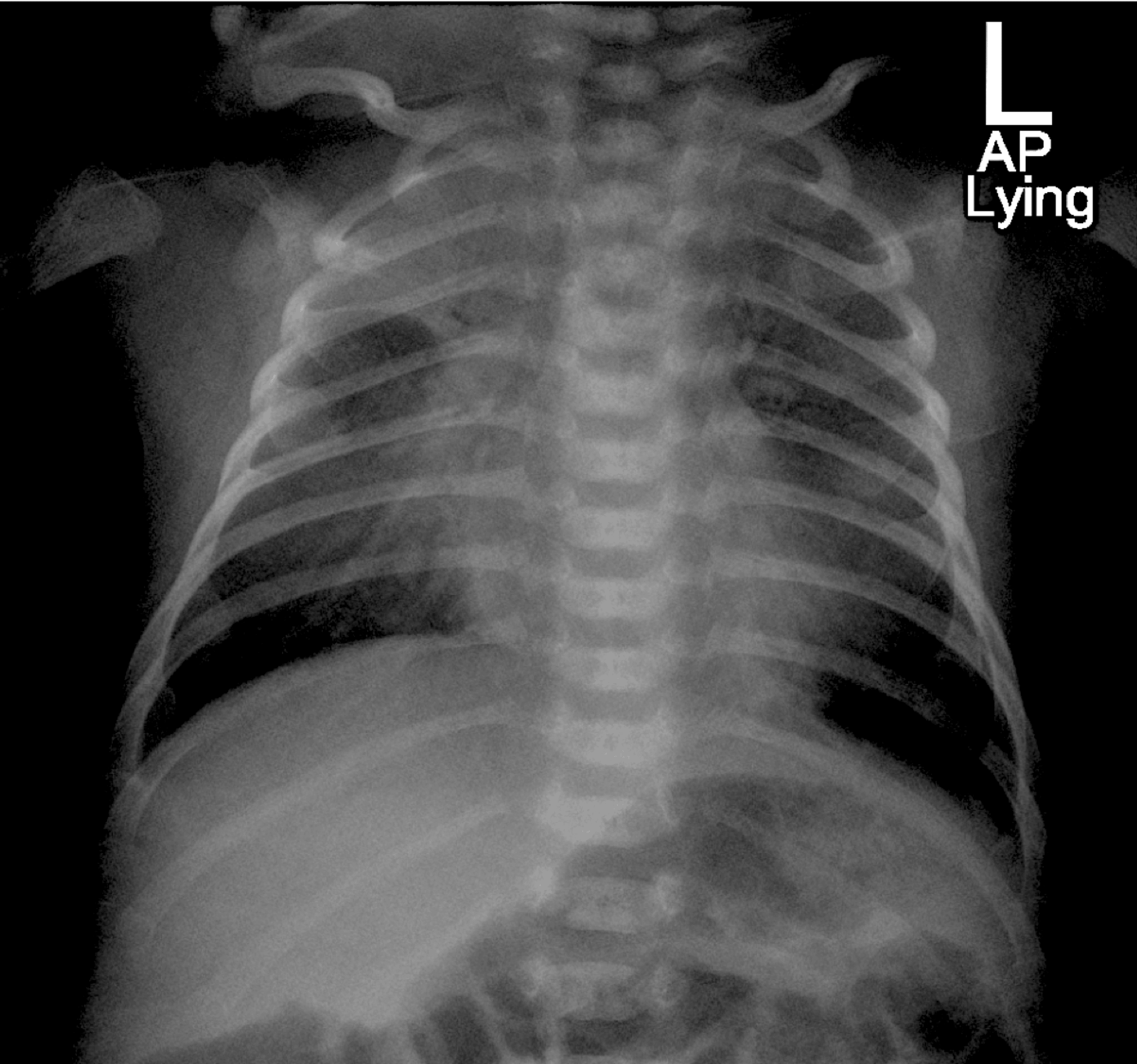 Adenosine Deaminase (ADA)-Deficient Severe Combined Immunodeficiency ...