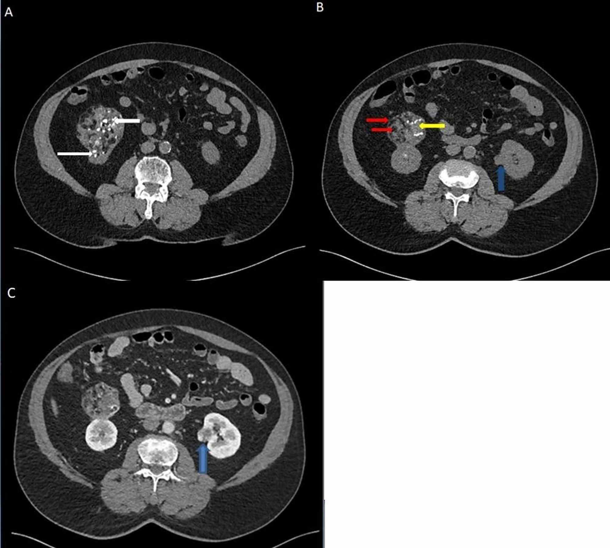 Cureus Fat Containing Renal Cell Carcinoma Mimicking Angiomyolipoma A Radiological And