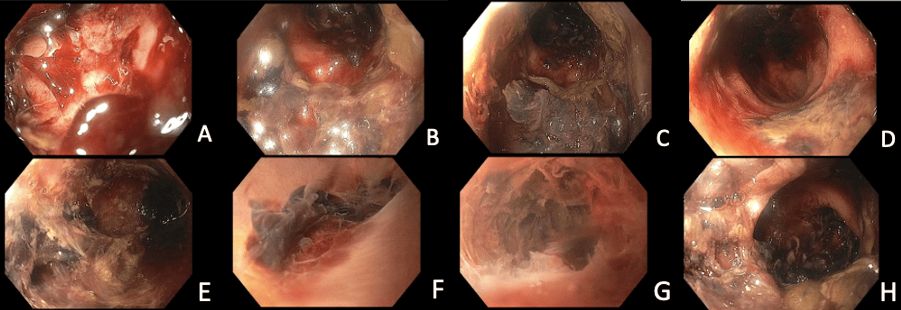 A Case Report of Refractory GraftVersusHost Disease Colitis Managed With Robotic Total