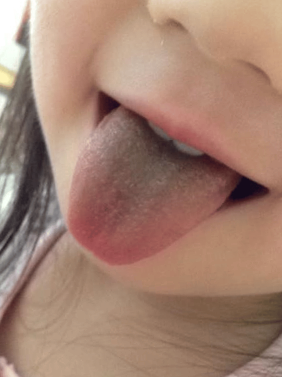 Black-hairy-tongue-during-linezolid-therapy-in-case-1.