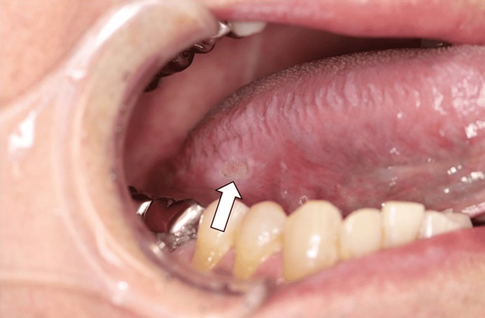 Owrzodzenie błony śluzowej jamy ustnej zakażone wirusem Epsteina-Barra prowadzące do zmian w jamie ustnej podczas jednoczesnego stosowania takrolimusu i prednizolonu.