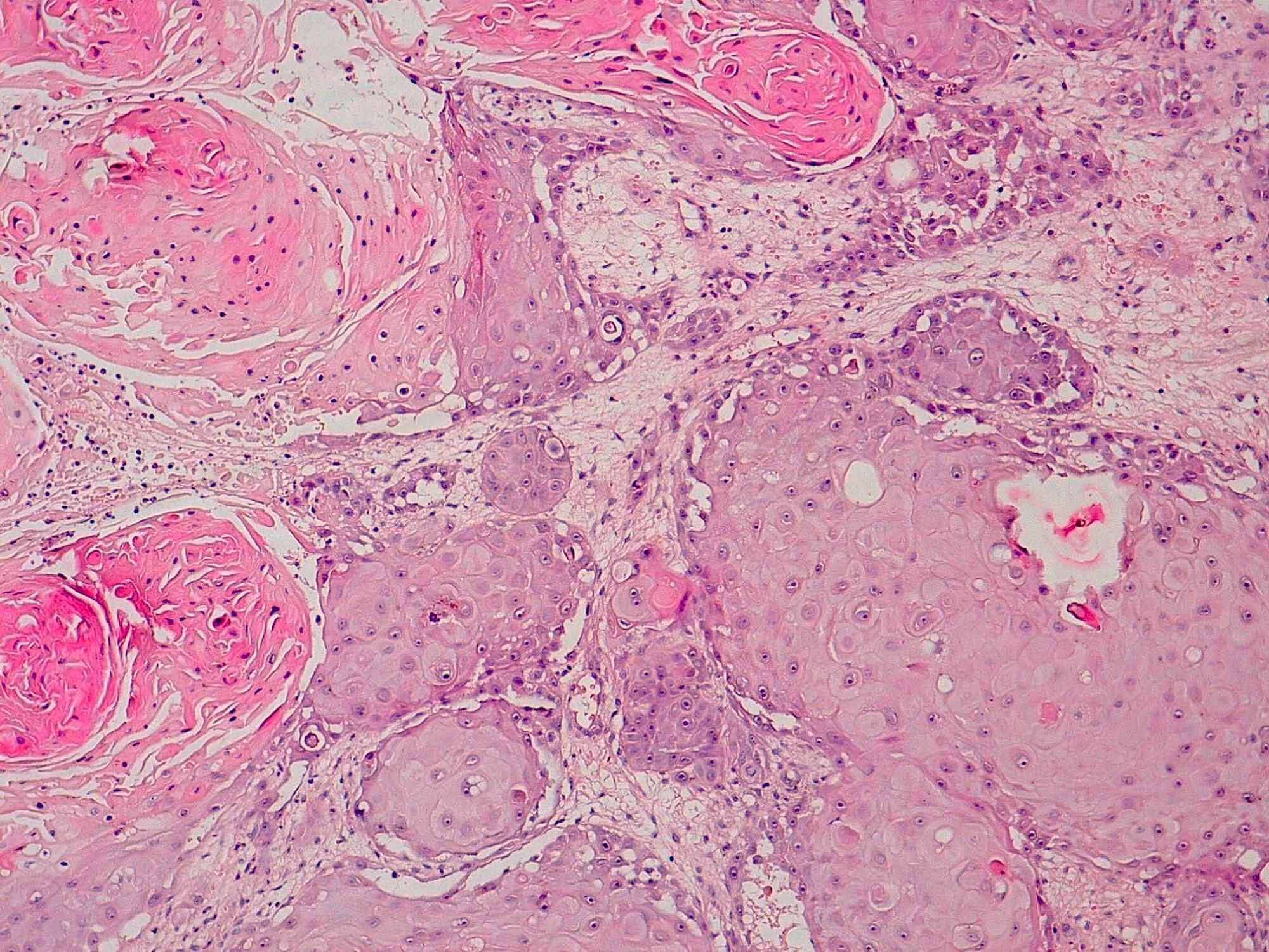 Cureus Breast Metastasis From a Nonsmall Cell Lung