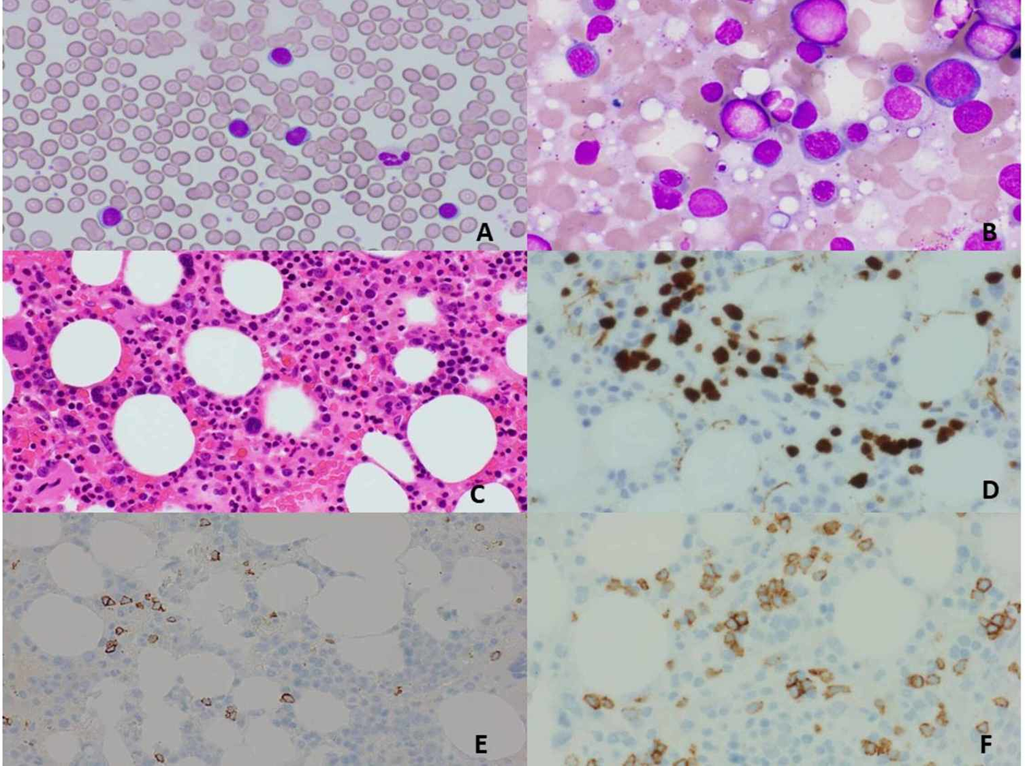 Cureus | A Rare Association: Autoimmune Hemolytic Anemia With Indolent ...