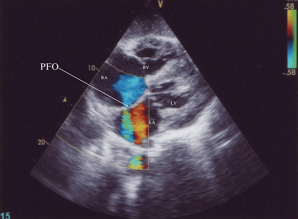 Echocardiogram-suggesting-the-presence-of-a-patent-foramen-ovale-(PFO).