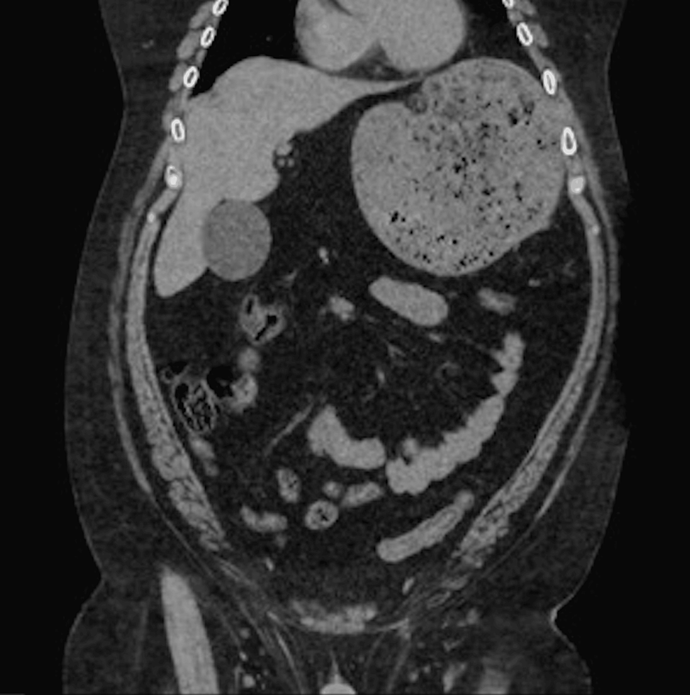 Cureus Endoscopic Reduction of an Acute Gastric Volvulus