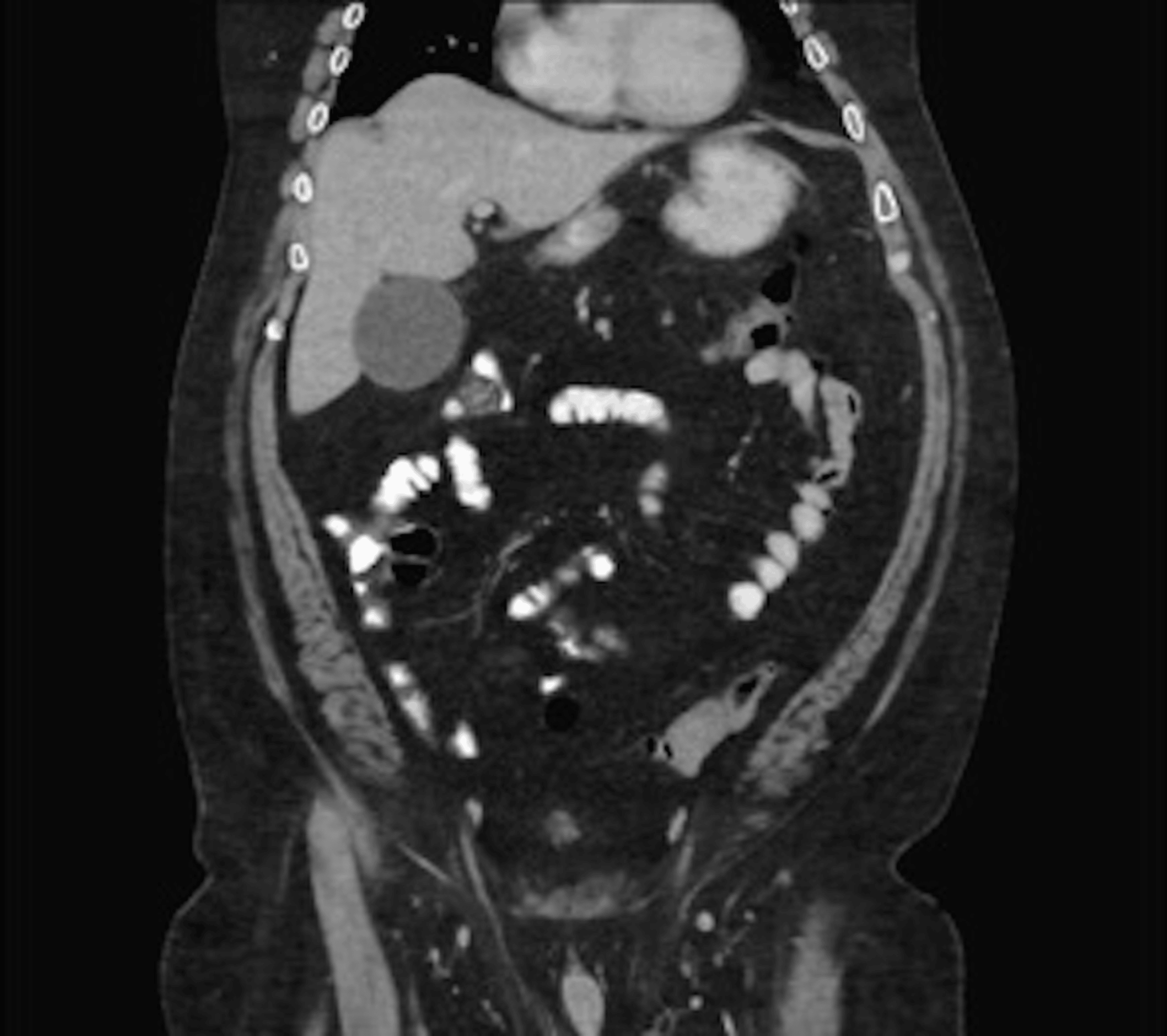 Cureus Endoscopic Reduction of an Acute Gastric Volvulus