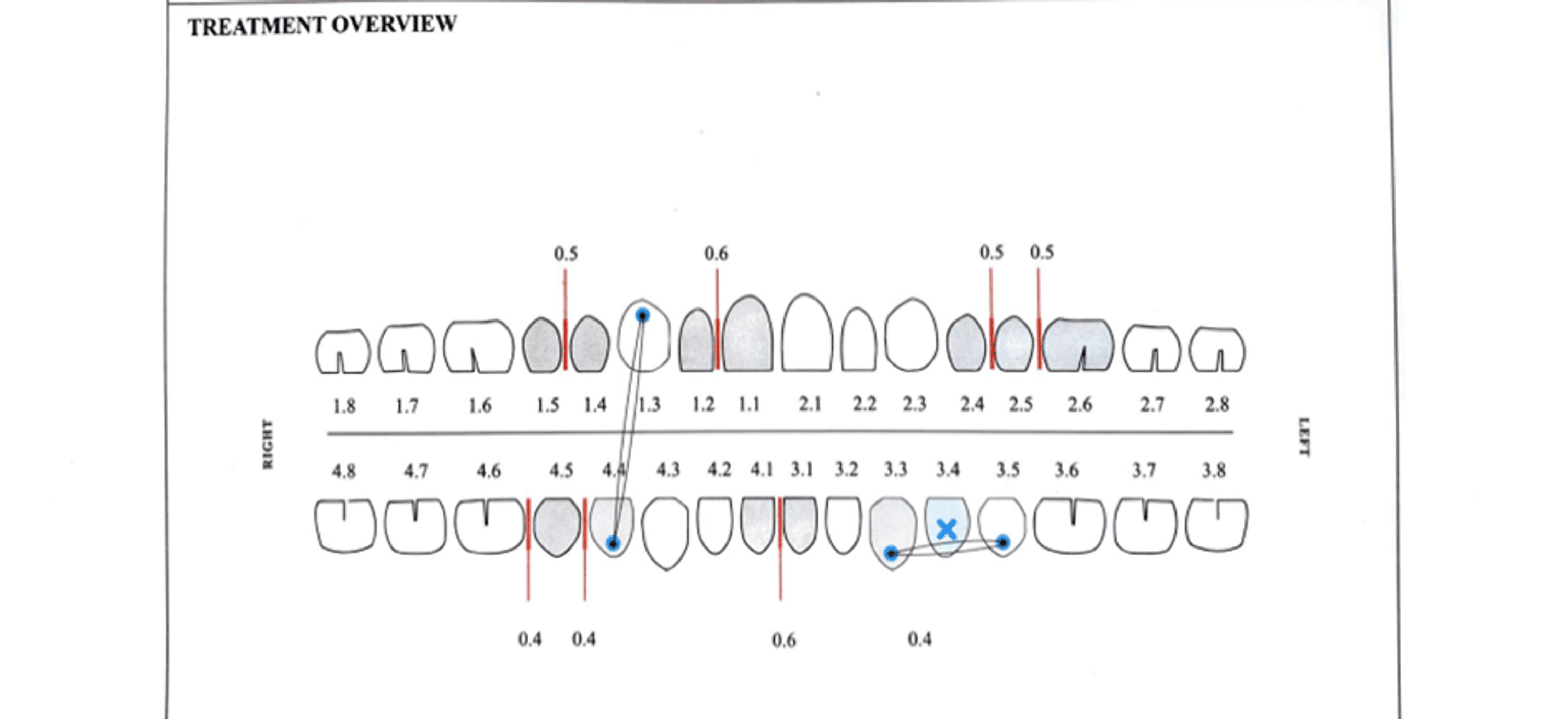Cureus The Role of Interproximal Reduction (IPR) in Clear Aligner