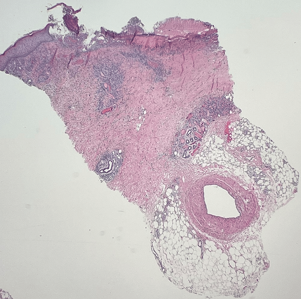 Cureus Livedoid Vasculopathy with Severe Debilitating Neuropathy in a
