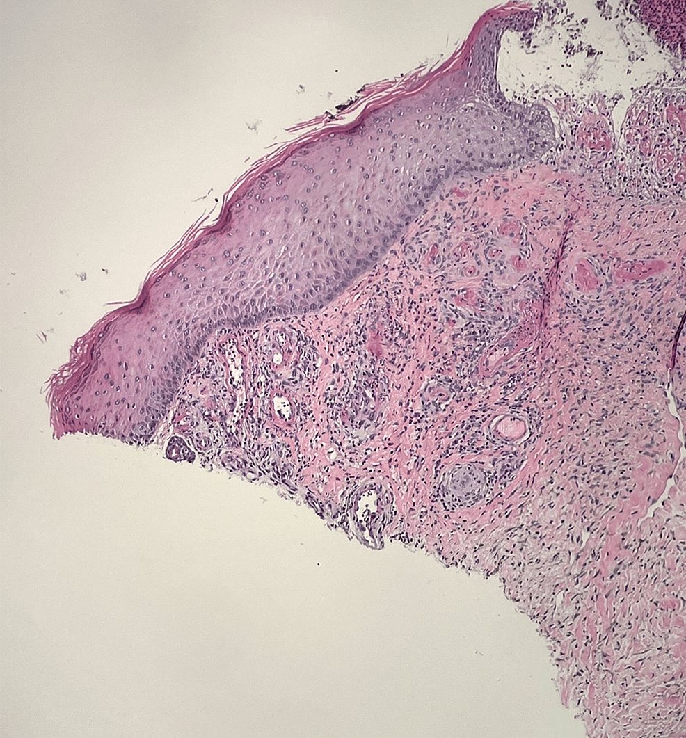 Cureus Livedoid Vasculopathy with Severe Debilitating Neuropathy in a