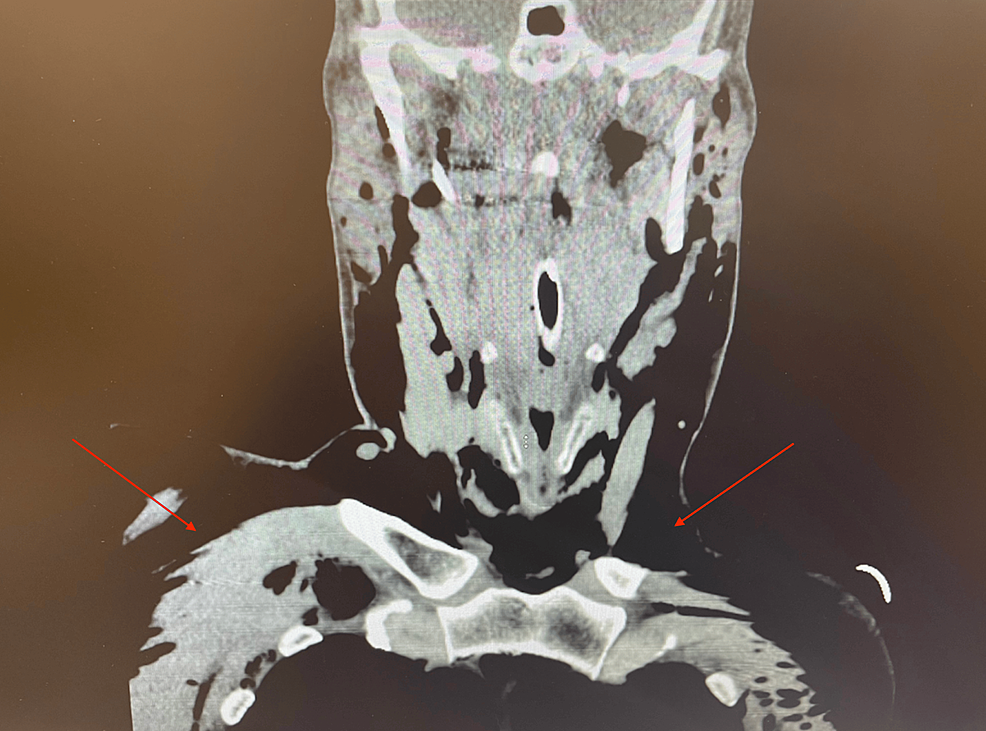 Cureus The Development of Extensive Subcutaneous Emphysema Following Robotic Total Abdominal