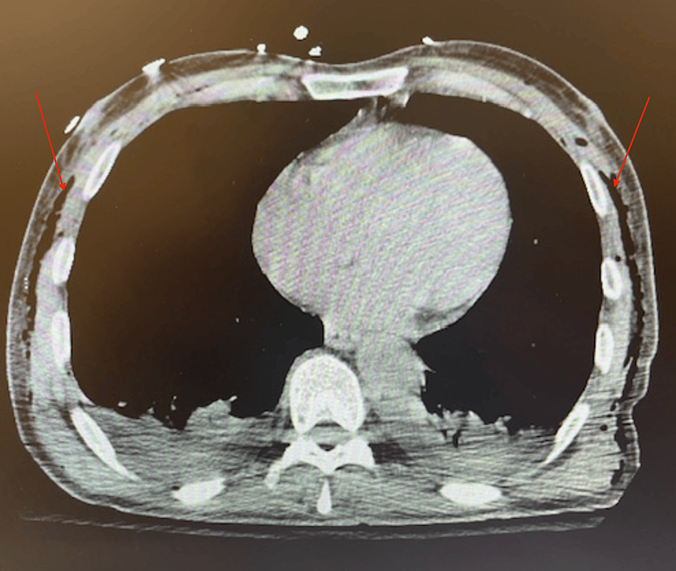 The Development of Extensive Subcutaneous Emphysema Following Robotic Total Abdominal Colectomy
