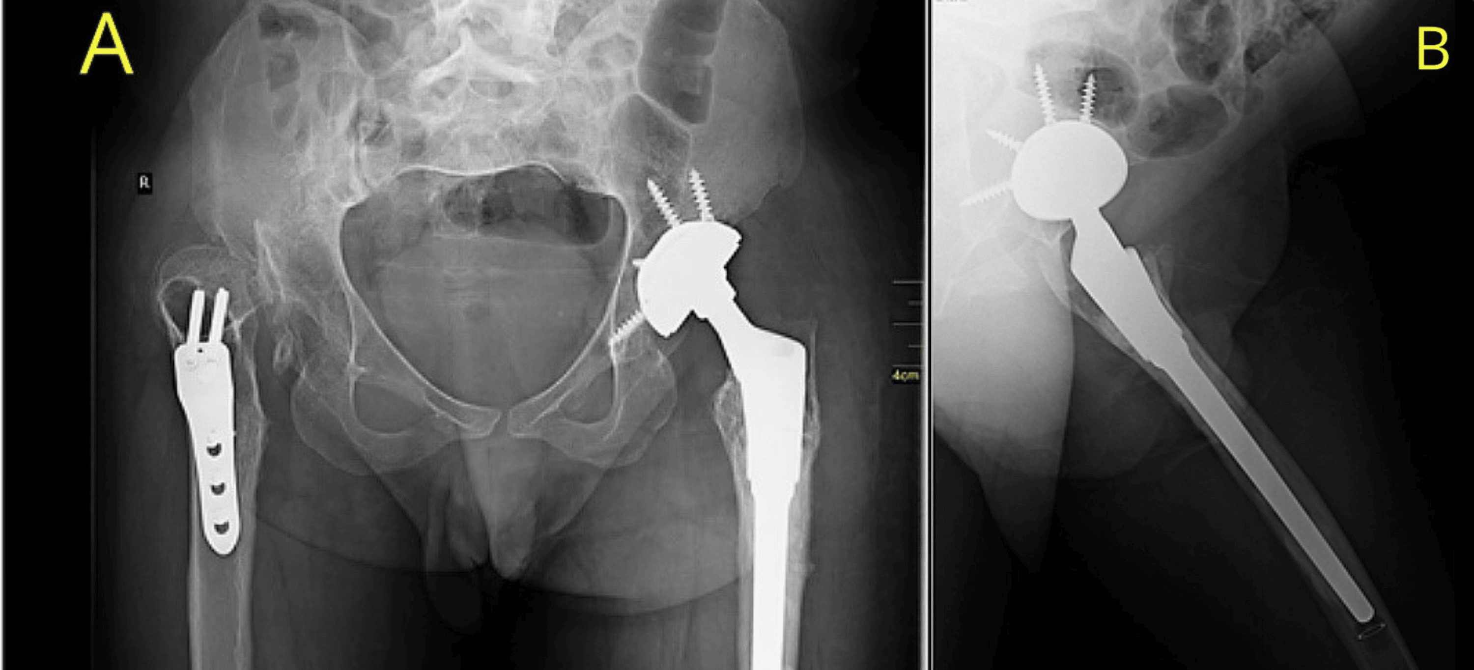 Optimizing Hip Replacement Procedure in Cerebral PalsyRelated Spastic Hip Dysplasia A Case