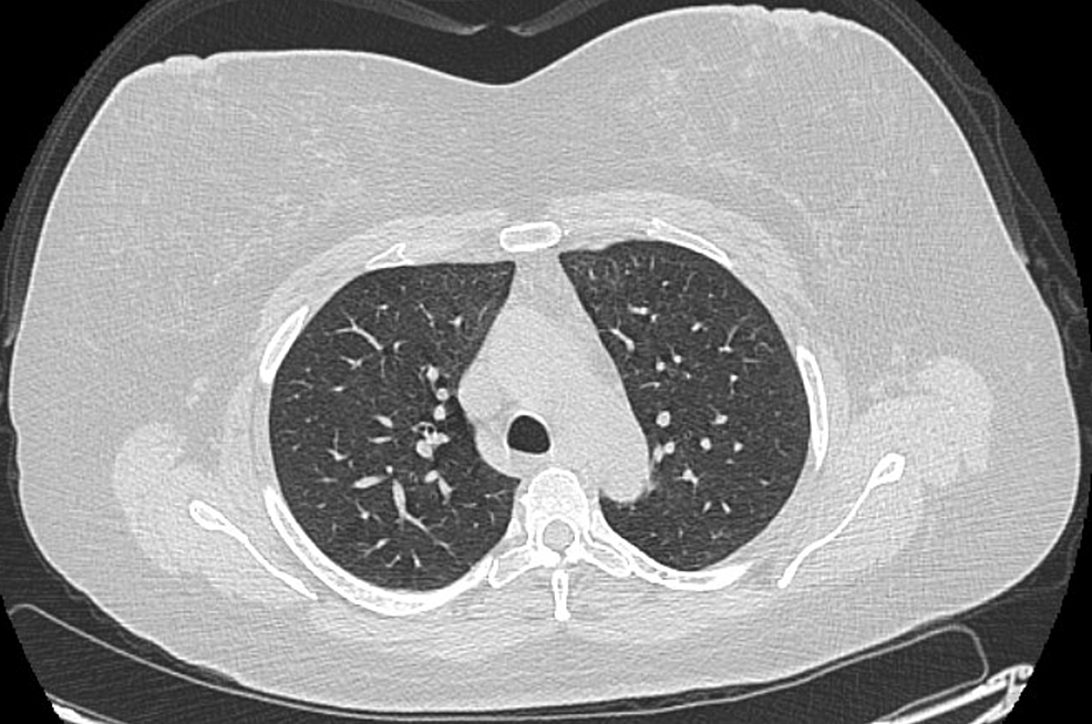 Follow-up-CT-chest-after-two-months