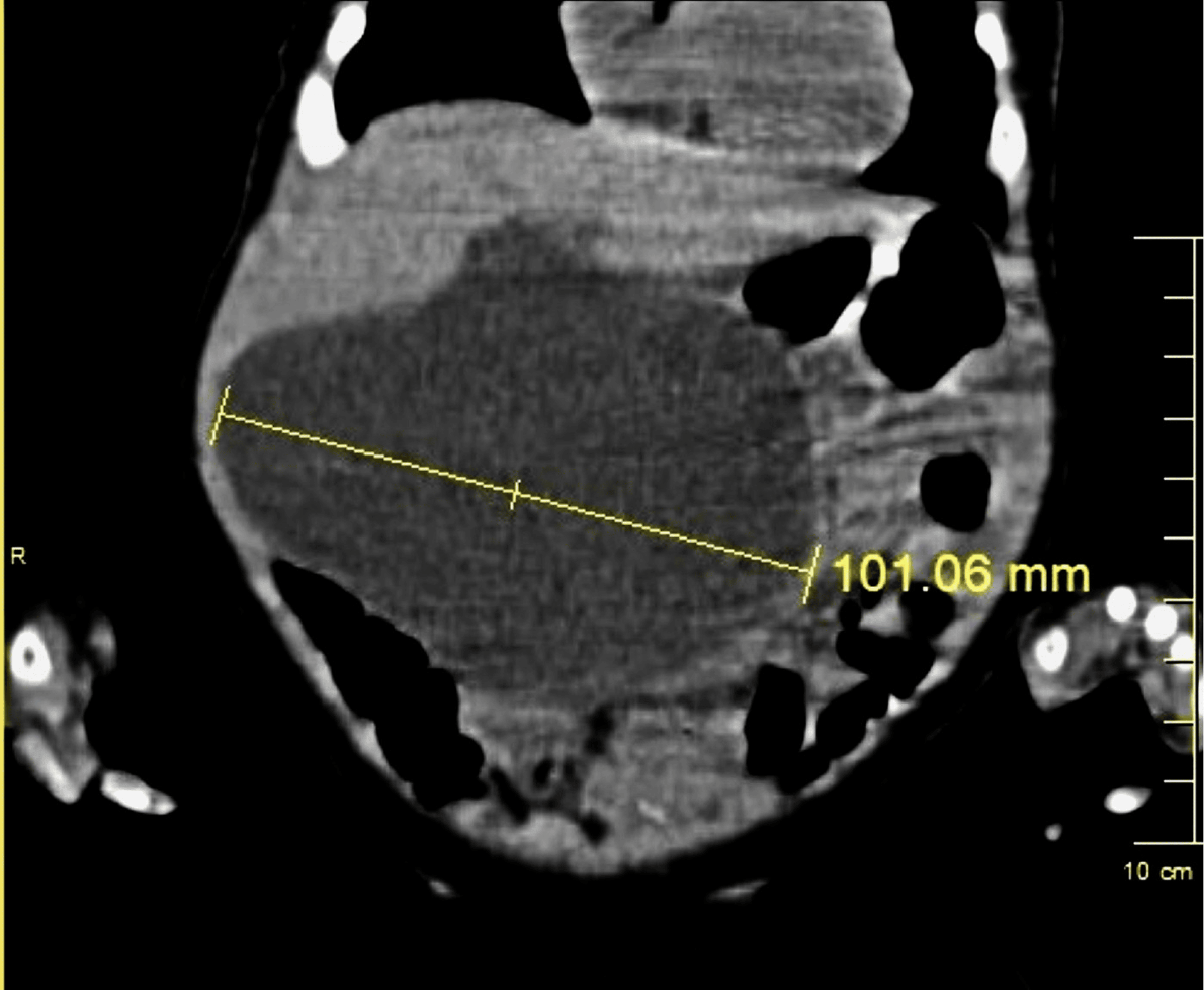 Largest Cyst Popped 54 - ij2j996