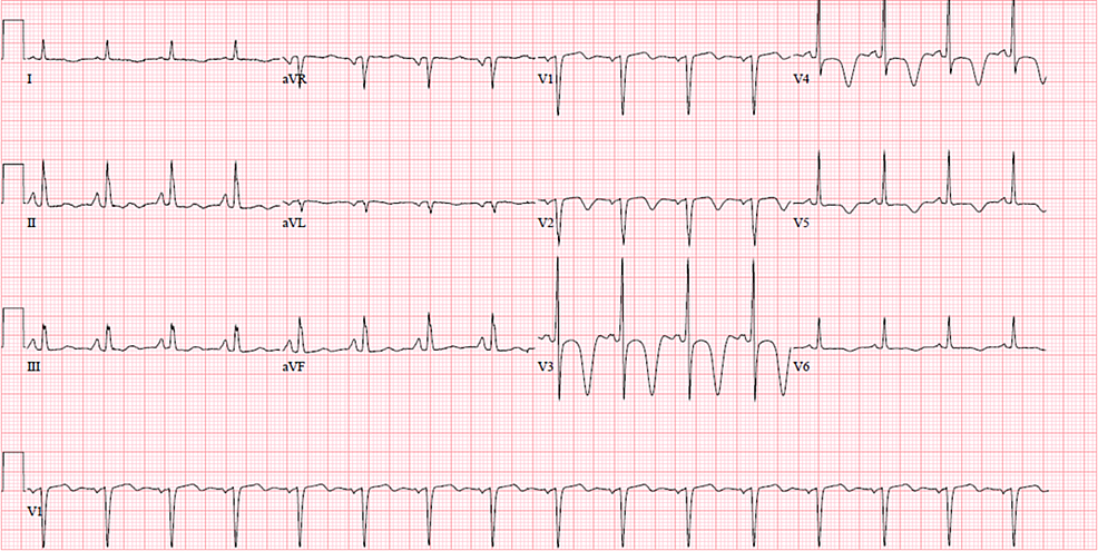 cureus-wellens-syndrome-presenting-as-epigastric-pain-and-syncope