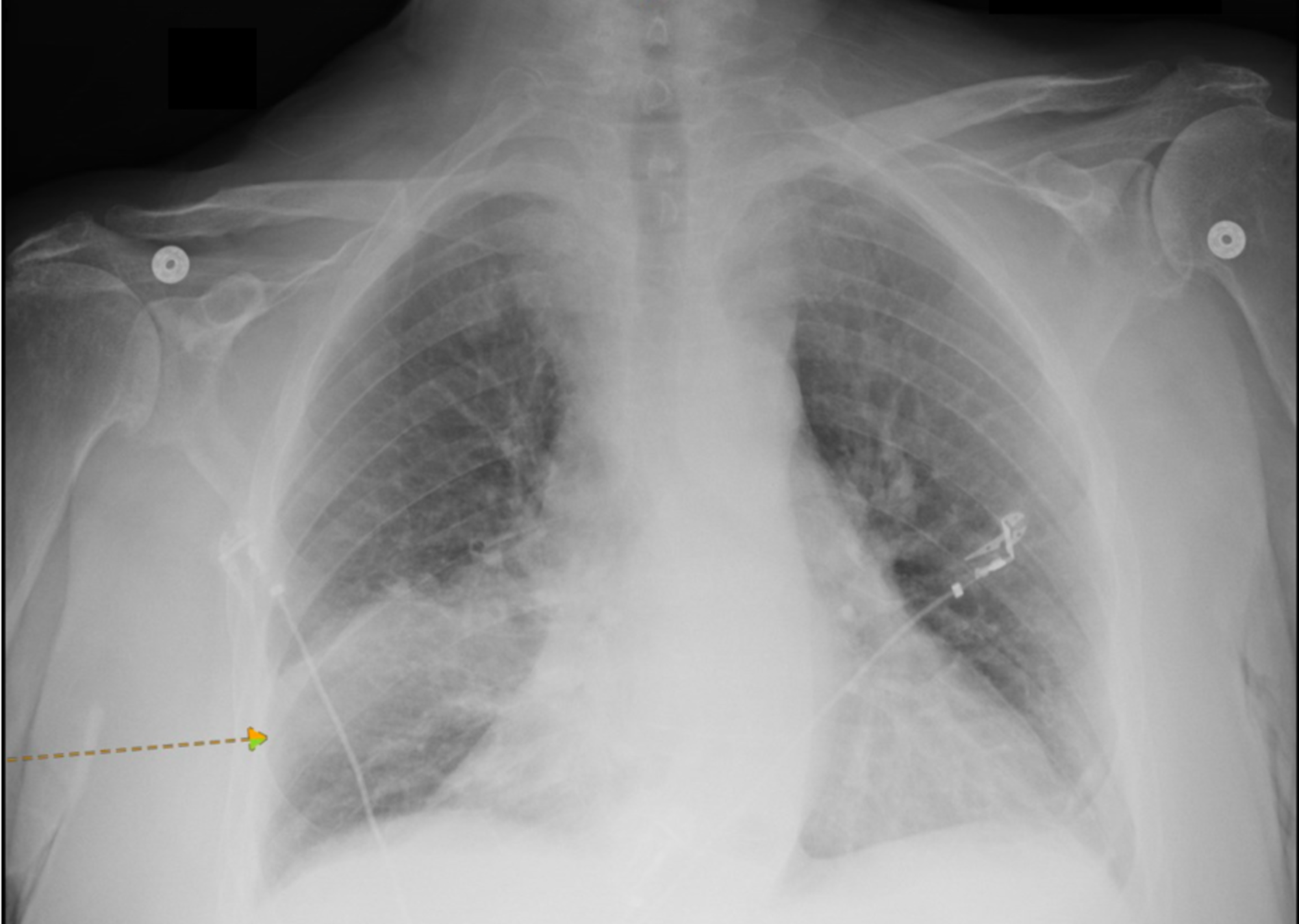 Cureus | A Transesophageal Echocardiogram Finding: From Infection to ...