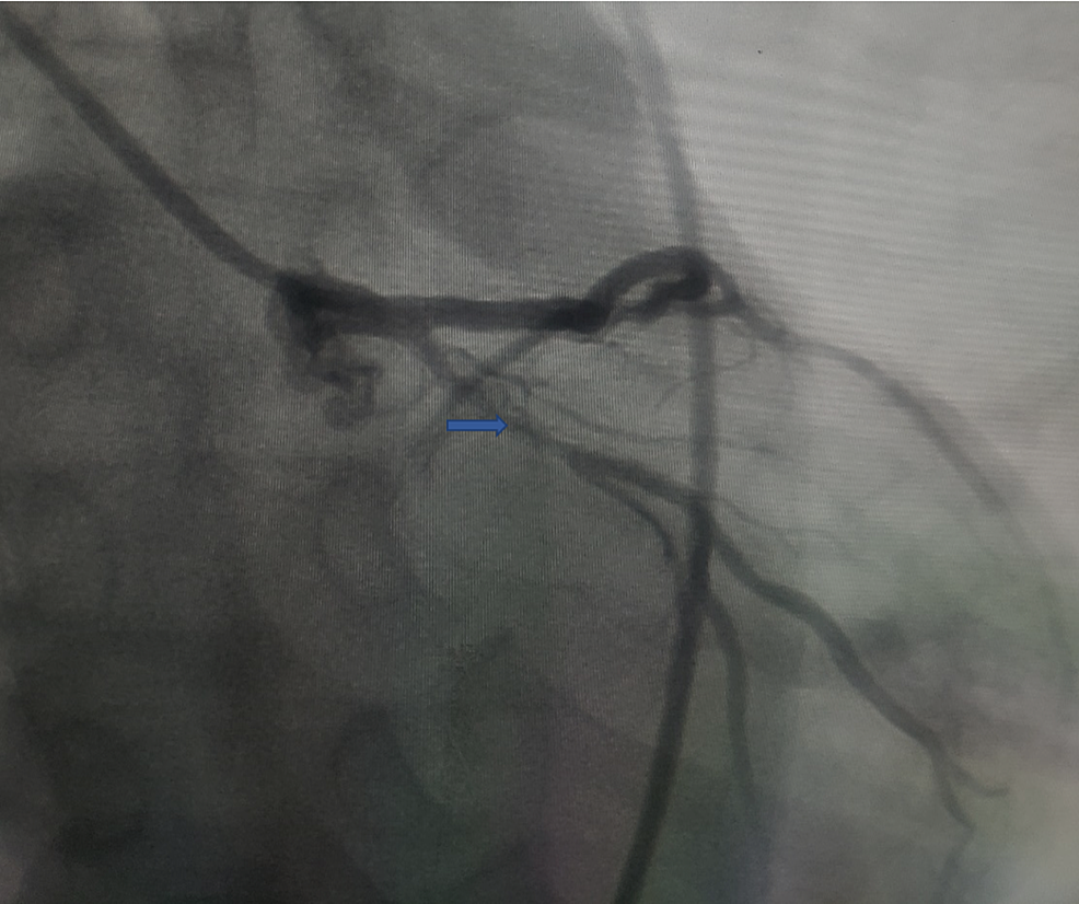 Cureus | Wellens’ Syndrome Presenting as Epigastric Pain and Syncope ...