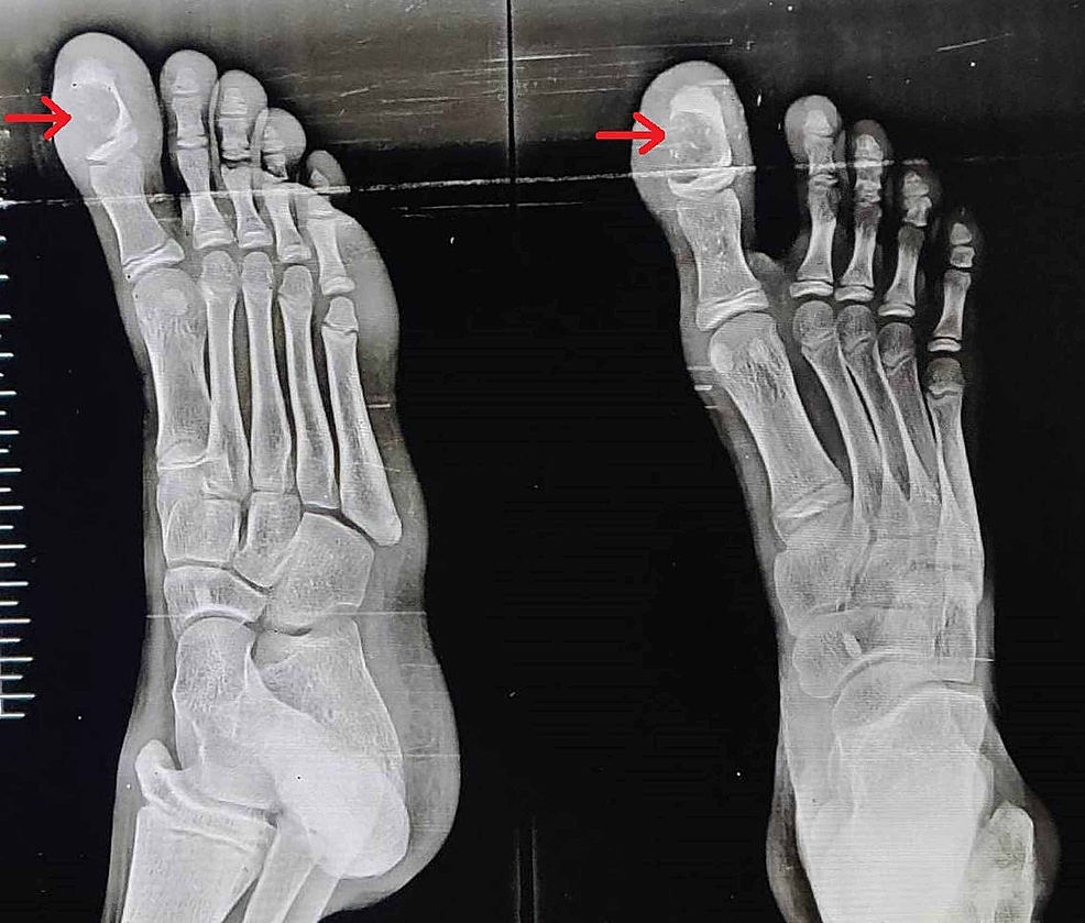 Great Toe Proximal Phalanx Fracture