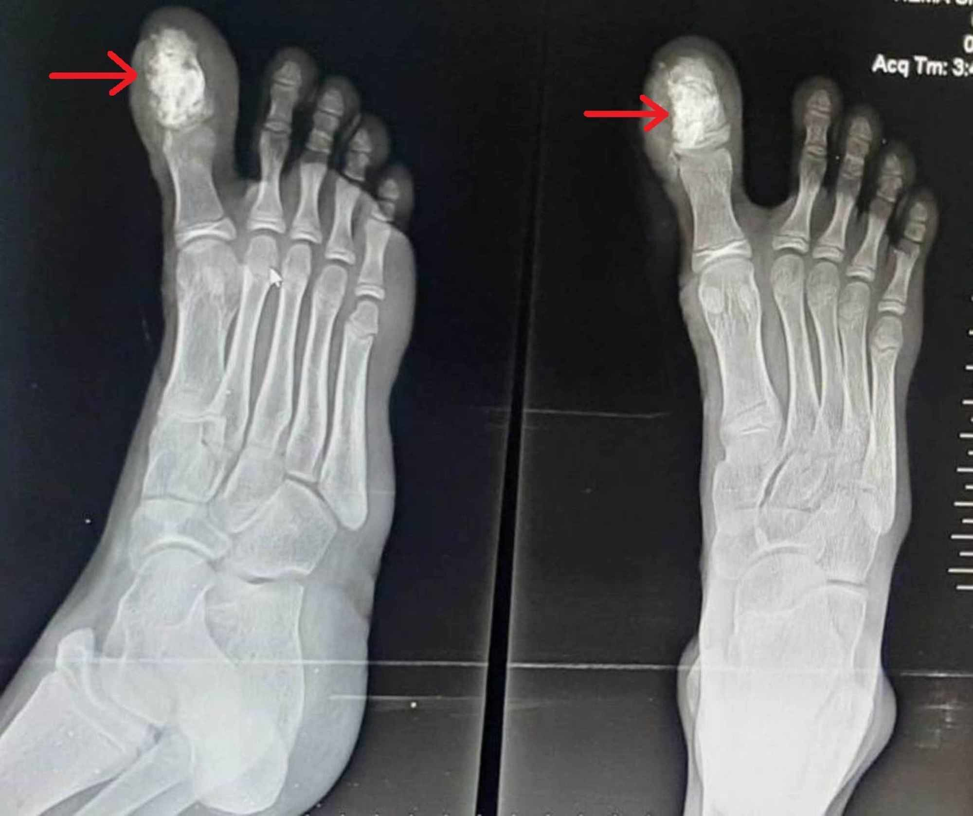 Osteoid Osteoma Of Distal Phalanx Of Toe A Rare Cause Of Foot Pain My
