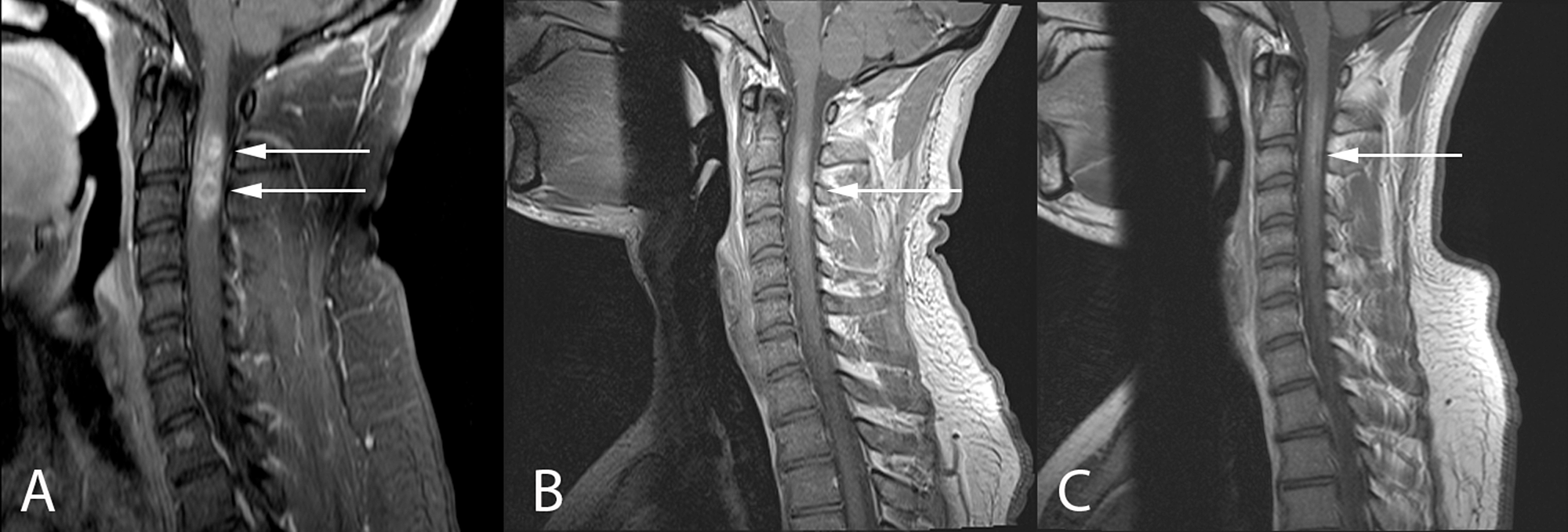 Pdf Imaging Of Intramedullary Spinal Cord Lesions On Mri