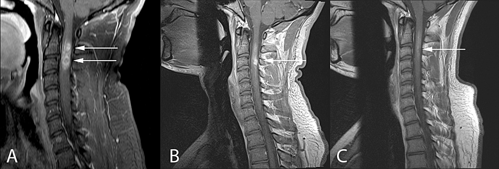 Cureus | Spontaneous Regression of a Symptomatic Intramedullary Spinal ...