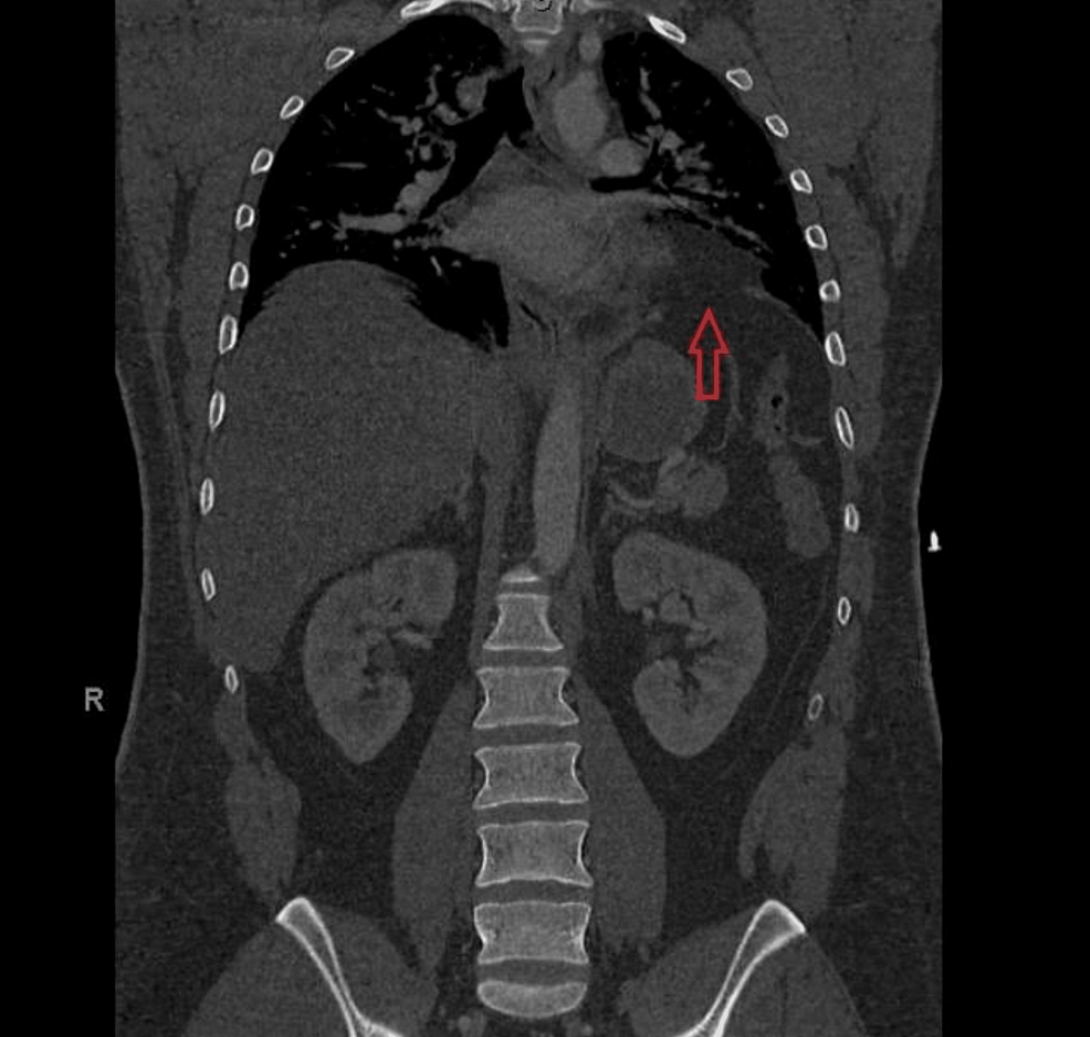 Transabdominal Minimally Invasive Repair of a Left Chronic Traumatic  Diaphragmatic Hernia