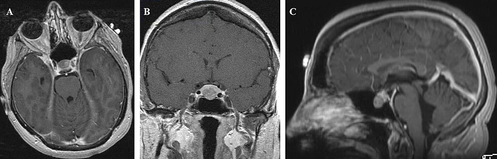 Rubinstein–Taybi syndrome: clinical and molecular overview