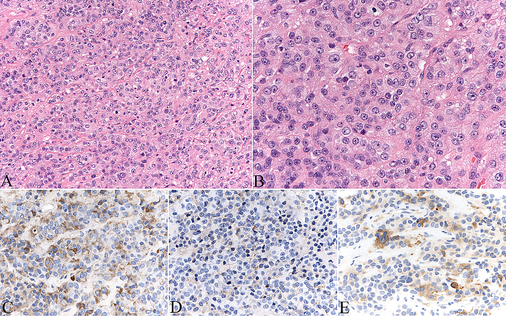 Histopathology Of The Pituitary Tumor Hematoxylin And Eosin Staining Porn Sex Picture 