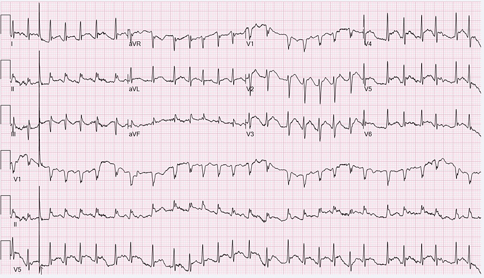 Bilateral Empyema With Beta Hemolytic Group C Streptococcus and ...