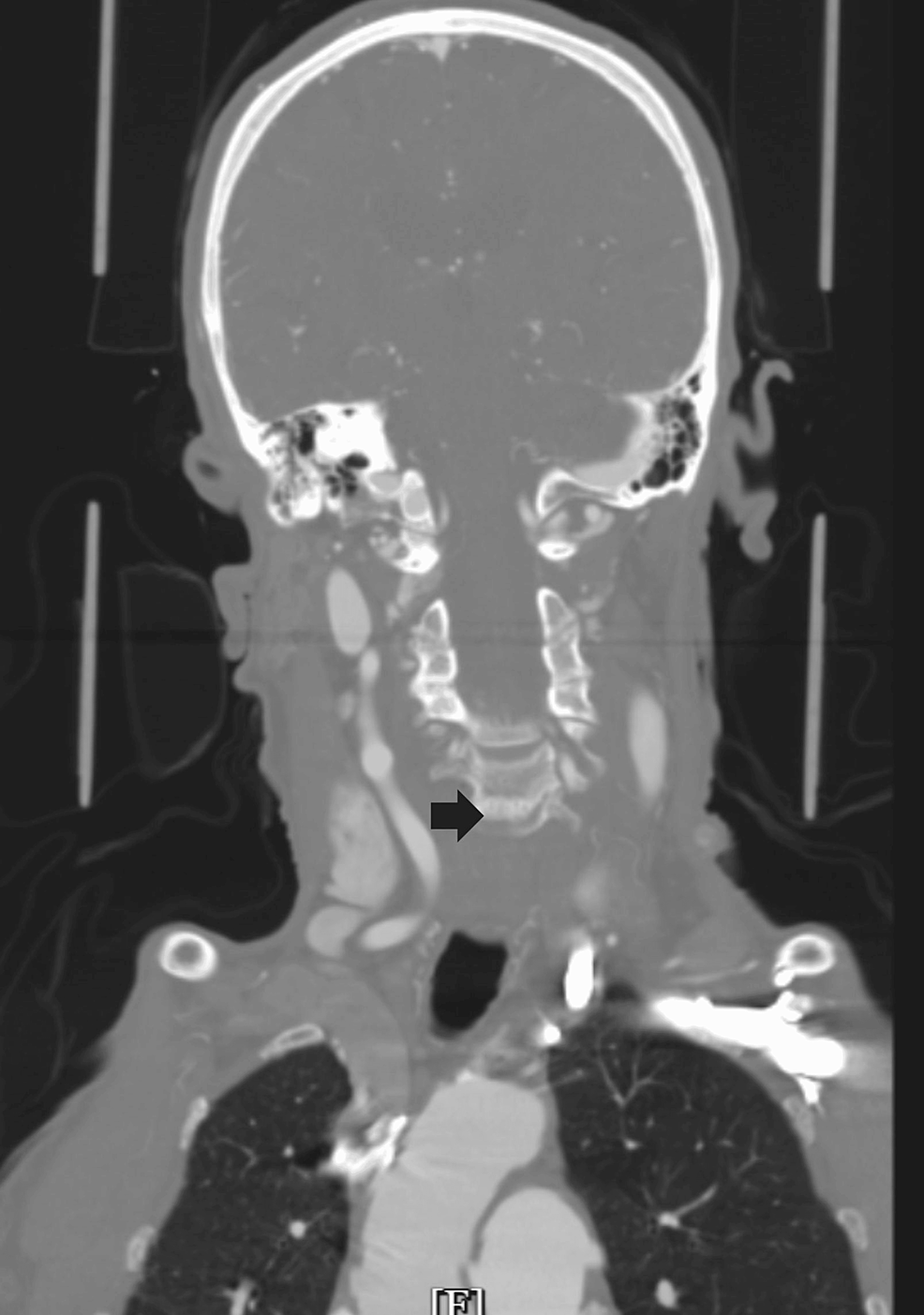 CTA-showing-occluded-common-and-internal-carotid-on-the-left-side-(indicated-by-the-black-arrow,-with-the-right-side-showing-a-patent-carotid-vessel).