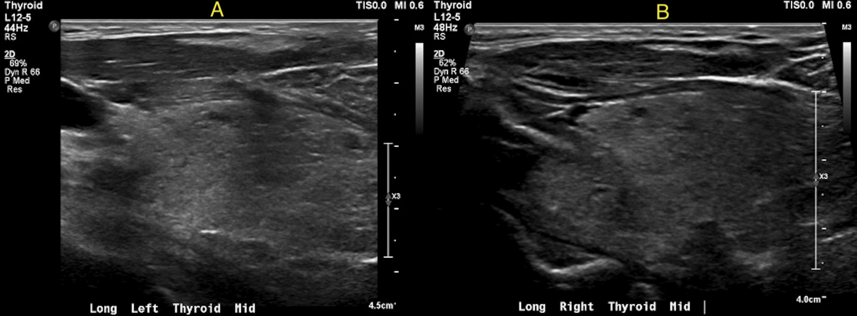 Cureus Rare Presentation of Thyrotoxicosis Defying Methimazole