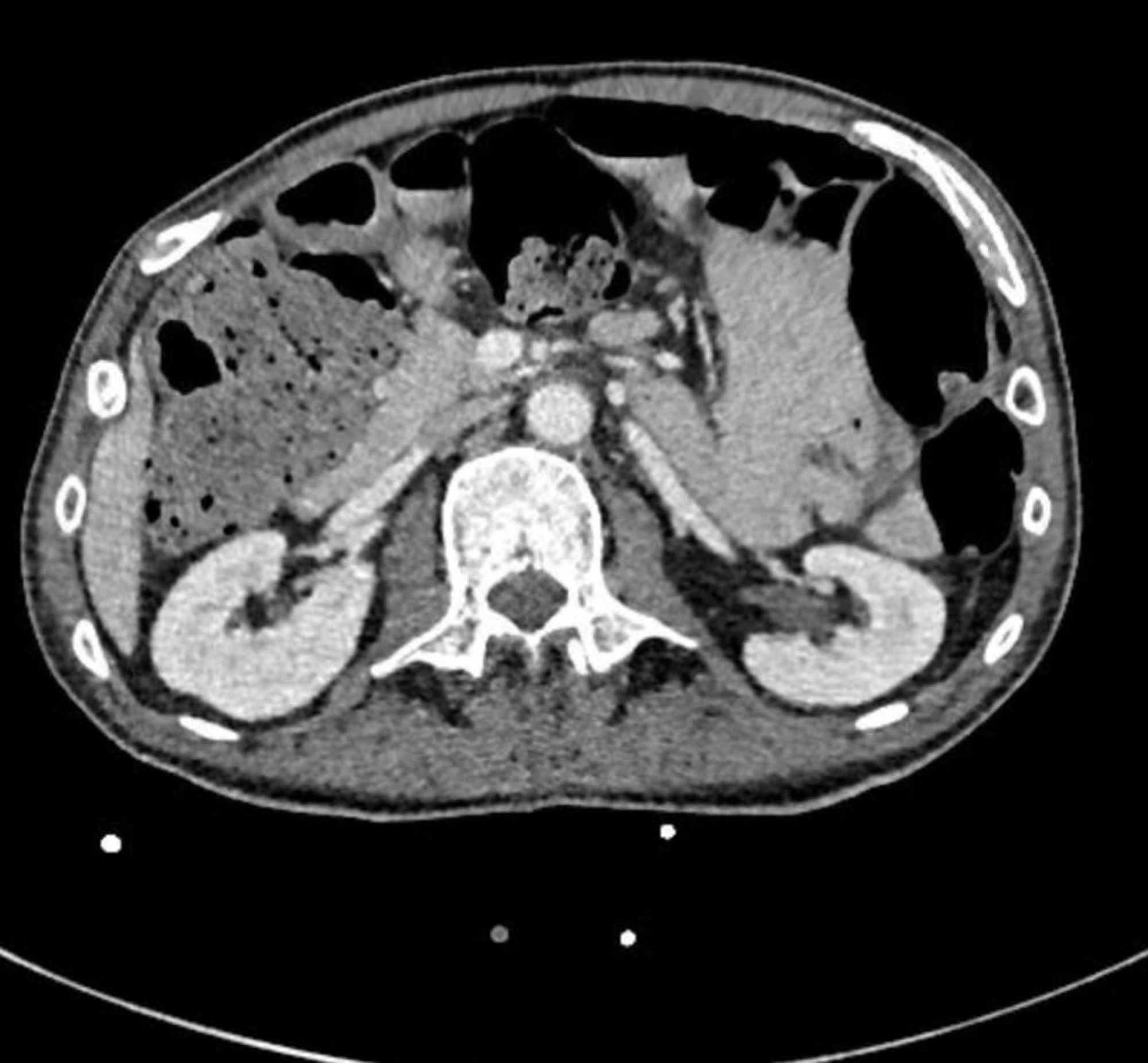 Cureus A Rare Case Of Prostatic And Bilateral Renal Abscesses Caused