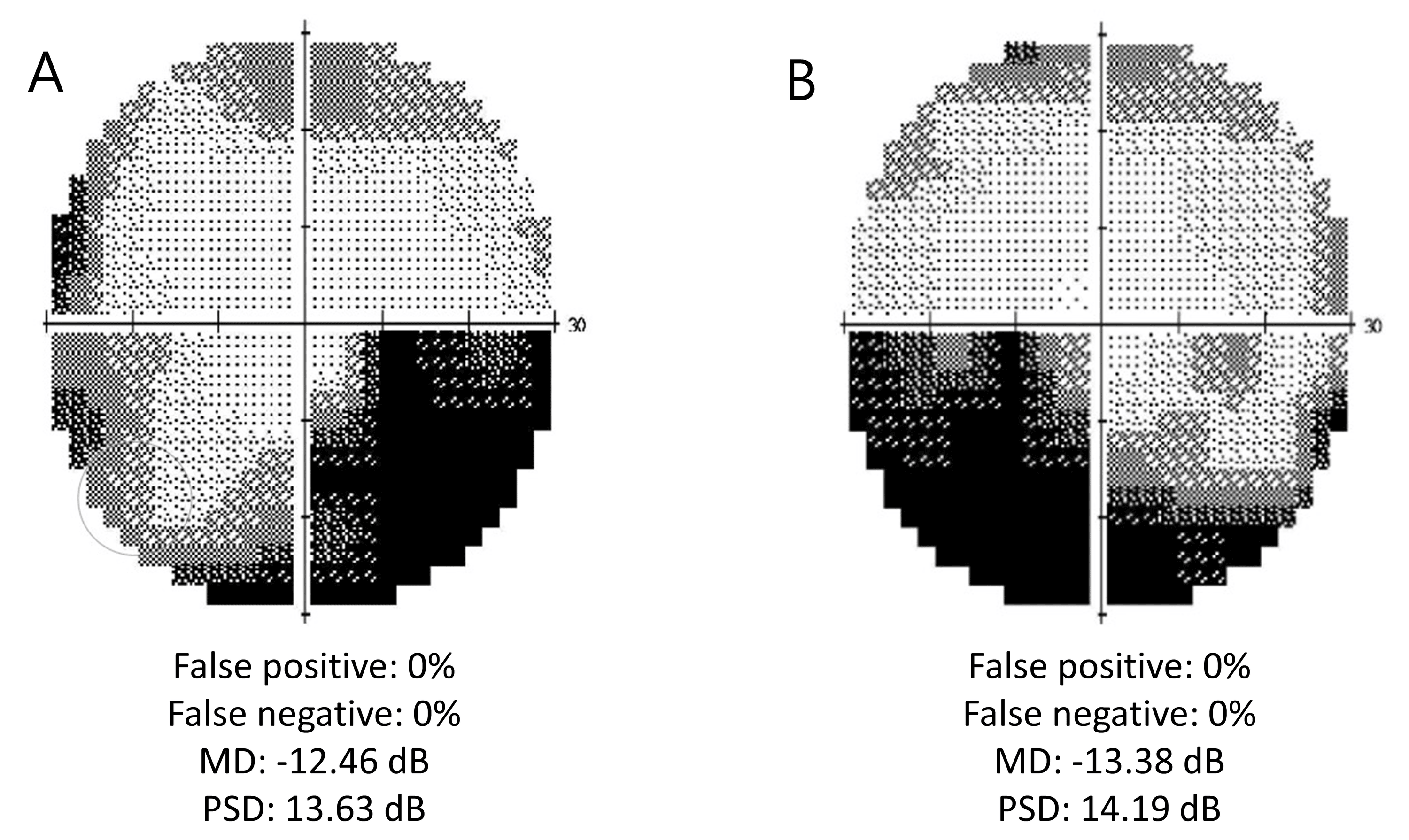 Binasal Quadrantanopia A Rare Visual Field Defect Poses Challenges In Terms Of Lesion