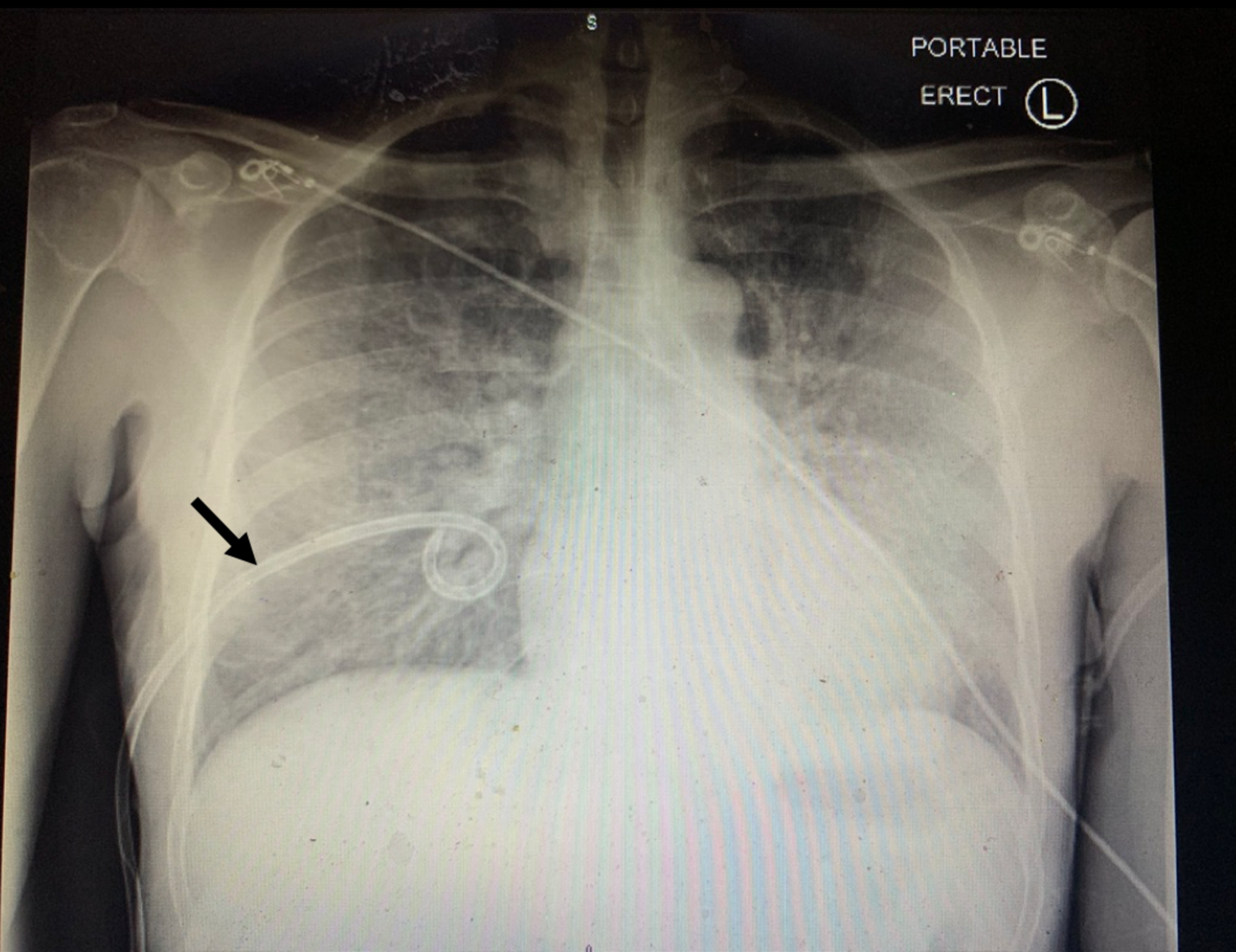 chest tube pneumothorax