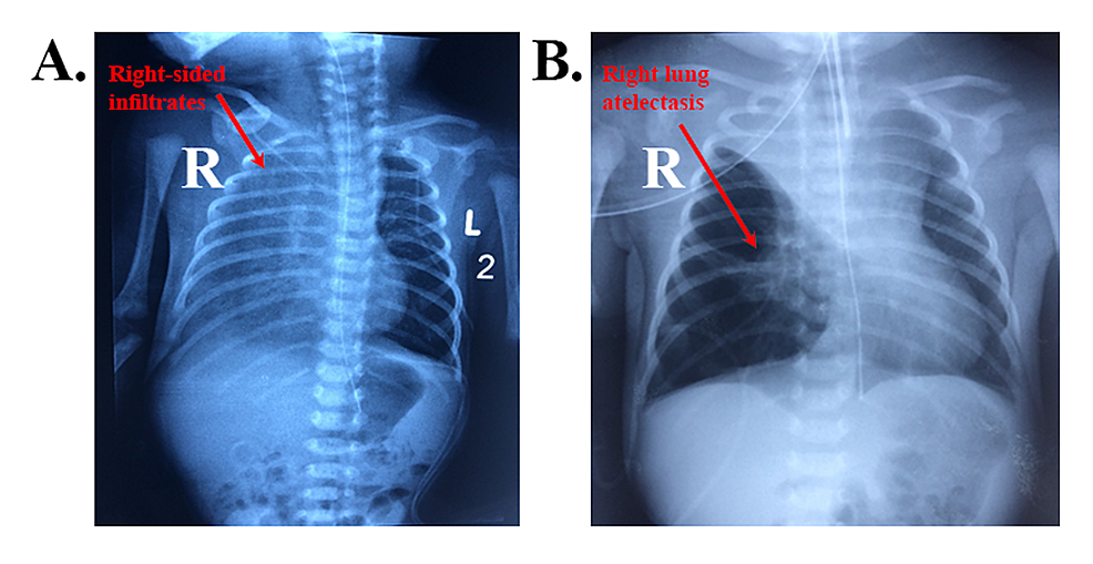 Cureus Early Diagnosis of Left Pulmonary Artery Sling During First