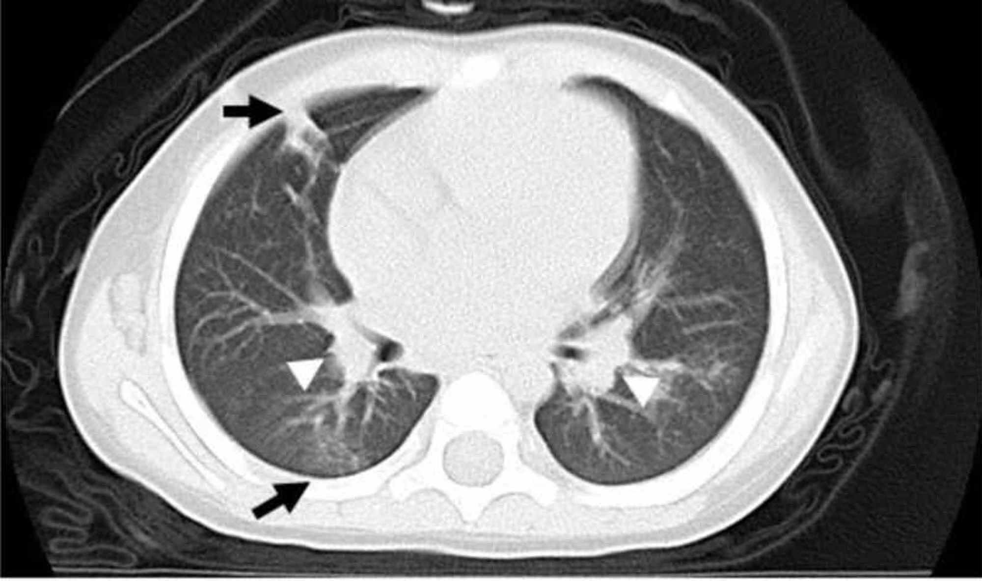 Cureus | The Difficulty of Diagnosing Kikuchi-Fujimoto Disease in ...