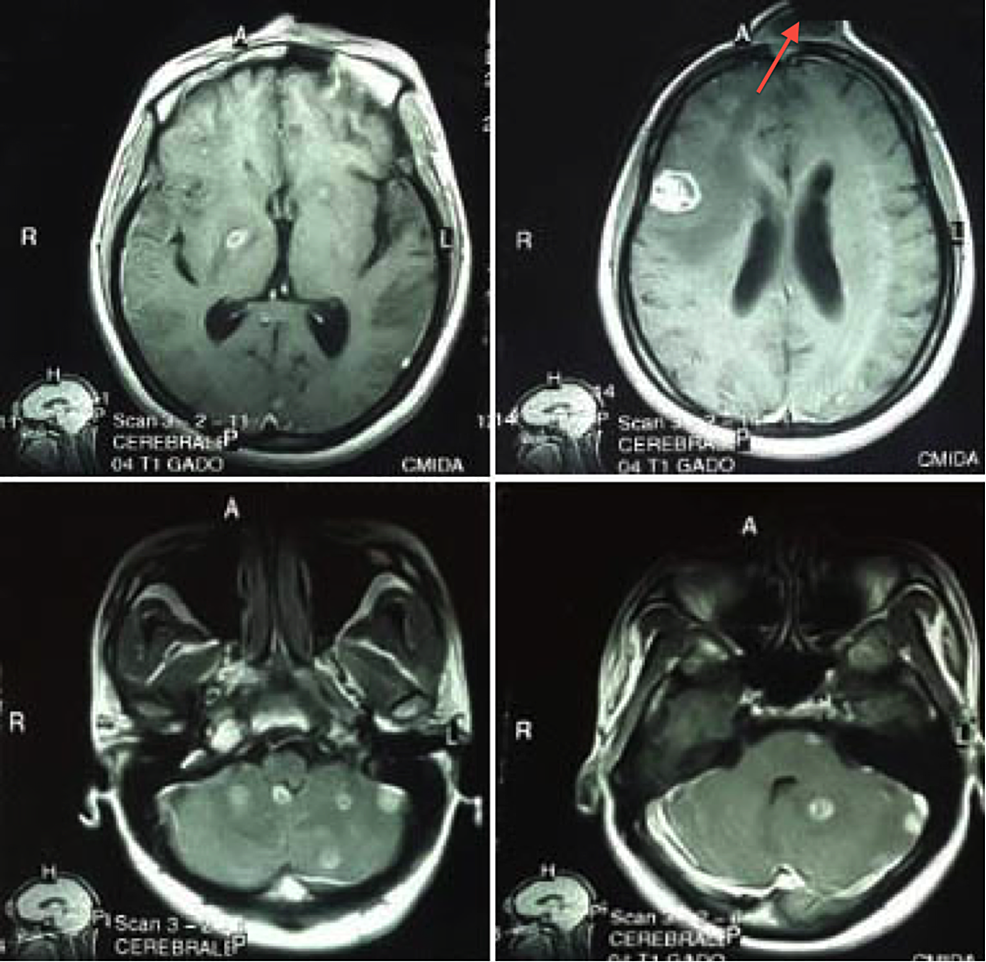 A Case of Histoplasma duboisii Brain Abscess and Review of the ...