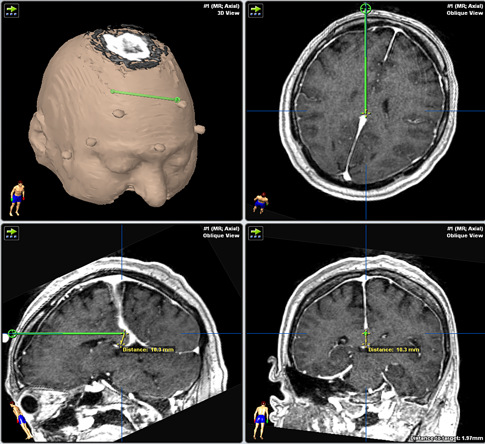 Cureus | Minimally Invasive Robotic Laser Corpus Callosotomy: A Proof ...