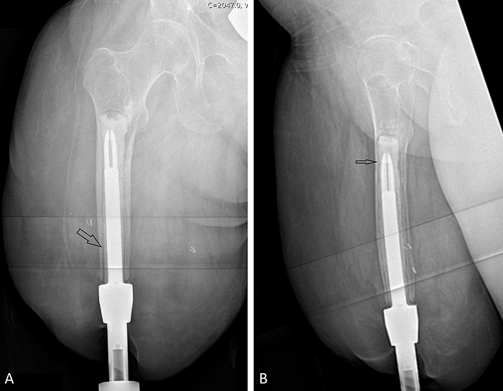 Cureus | Cementing Osseointegration Implants Results In Loosening: Case ...