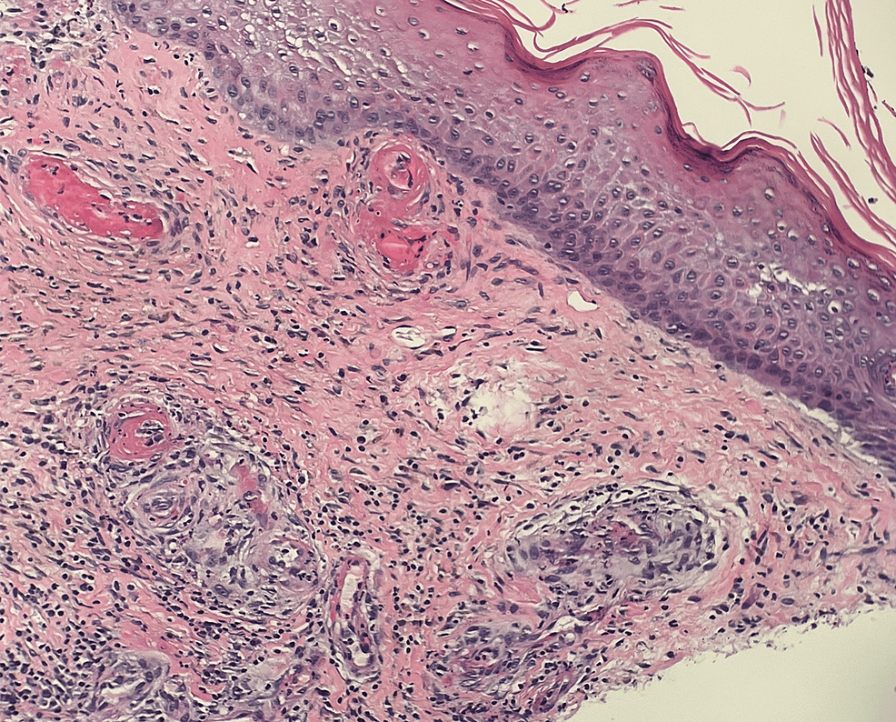 Cureus Livedoid Vasculopathy with Severe Debilitating Neuropathy in a